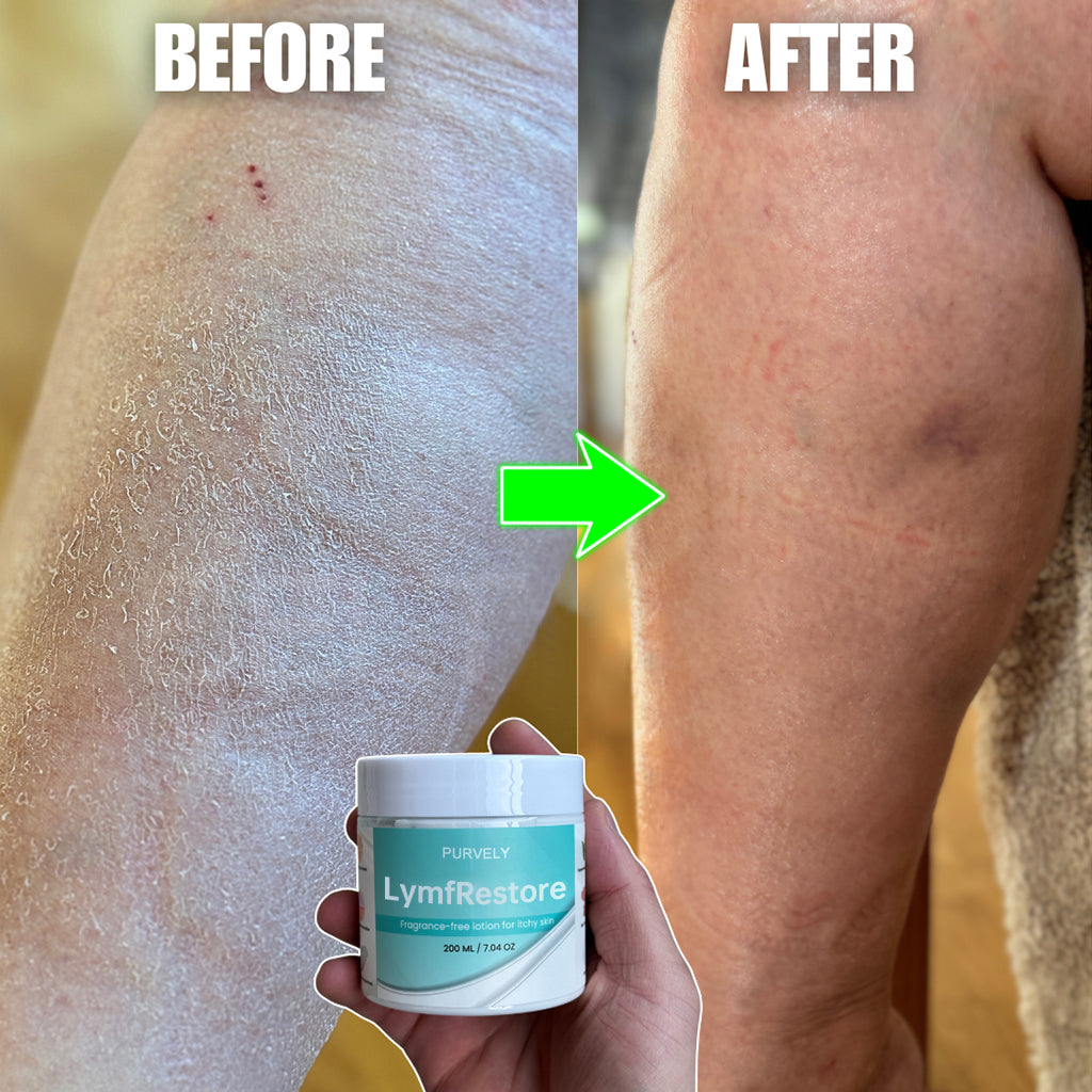 Fragrance-Free Non-Greasy Anti-Itch Ceramide NP Lotion For Dry, Red, Sensitive, Discolored, Weeping Skin