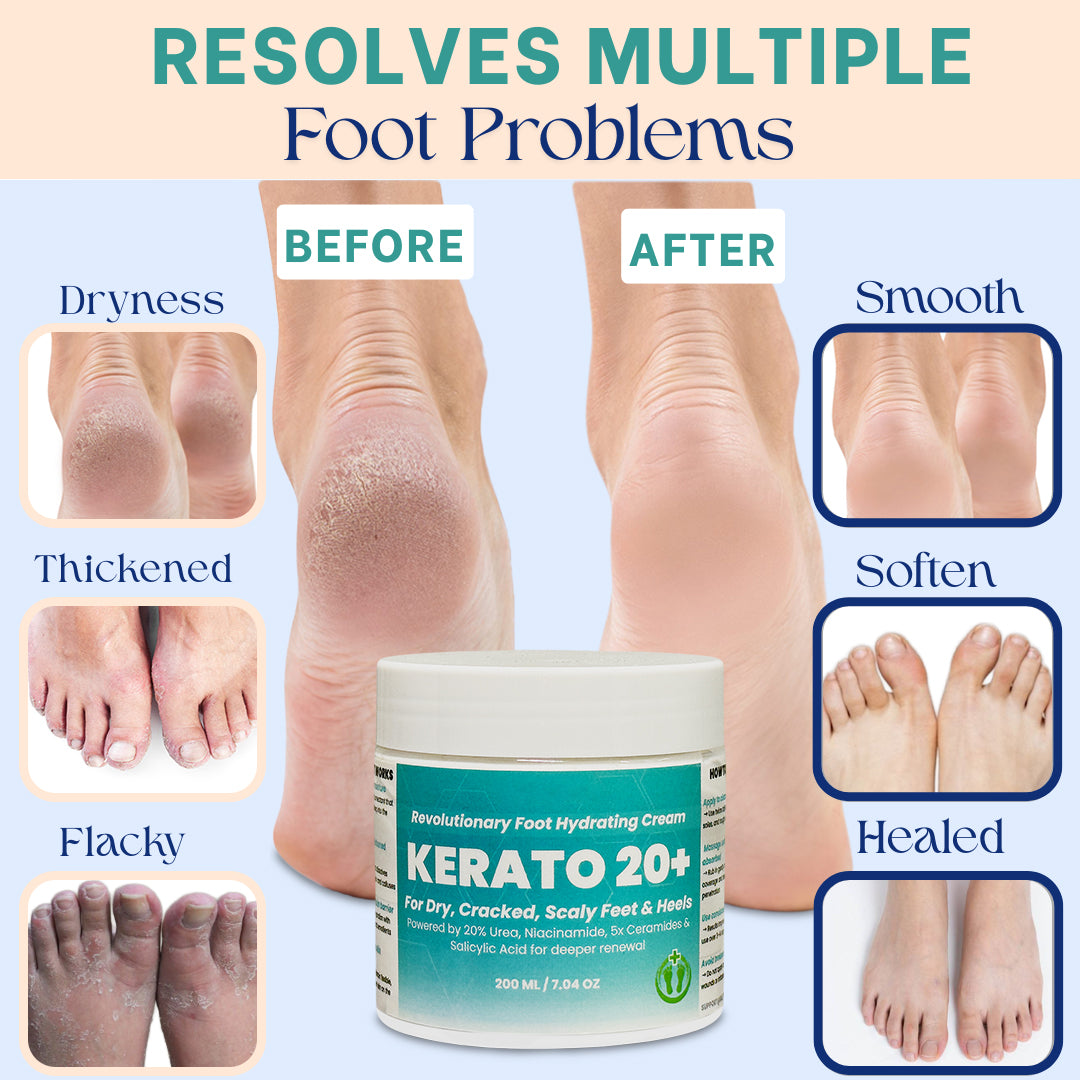 Urea 20% Intense Foot Hydrating Cream For Dry, & Cracked Feet, Non-Greasy