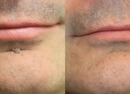 2-in-1 Microneedle & Hydrocolloid Patch🍀| Removes Raised Moles, Acne, Flat Warts & Skin Tags | Helps Improve Wrinkles, Scars & Blemishes | Invisible Patches for Face & Body