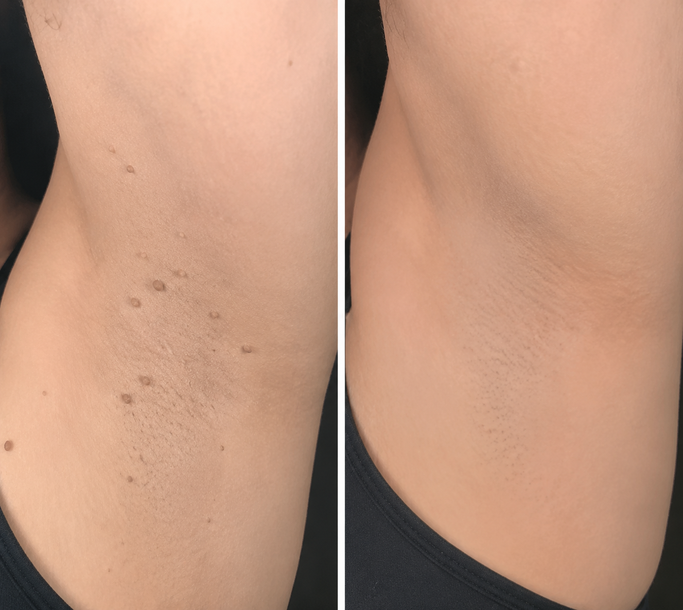 2-in-1 Microneedle & Hydrocolloid Patch🍀| Removes Raised Moles, Acne, Flat Warts & Skin Tags | Helps Improve Wrinkles, Scars & Blemishes | Invisible Patches for Face & Body